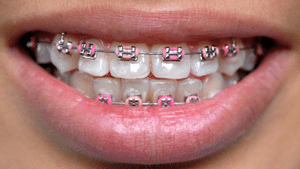 Types of braces Marietta Roswell GA