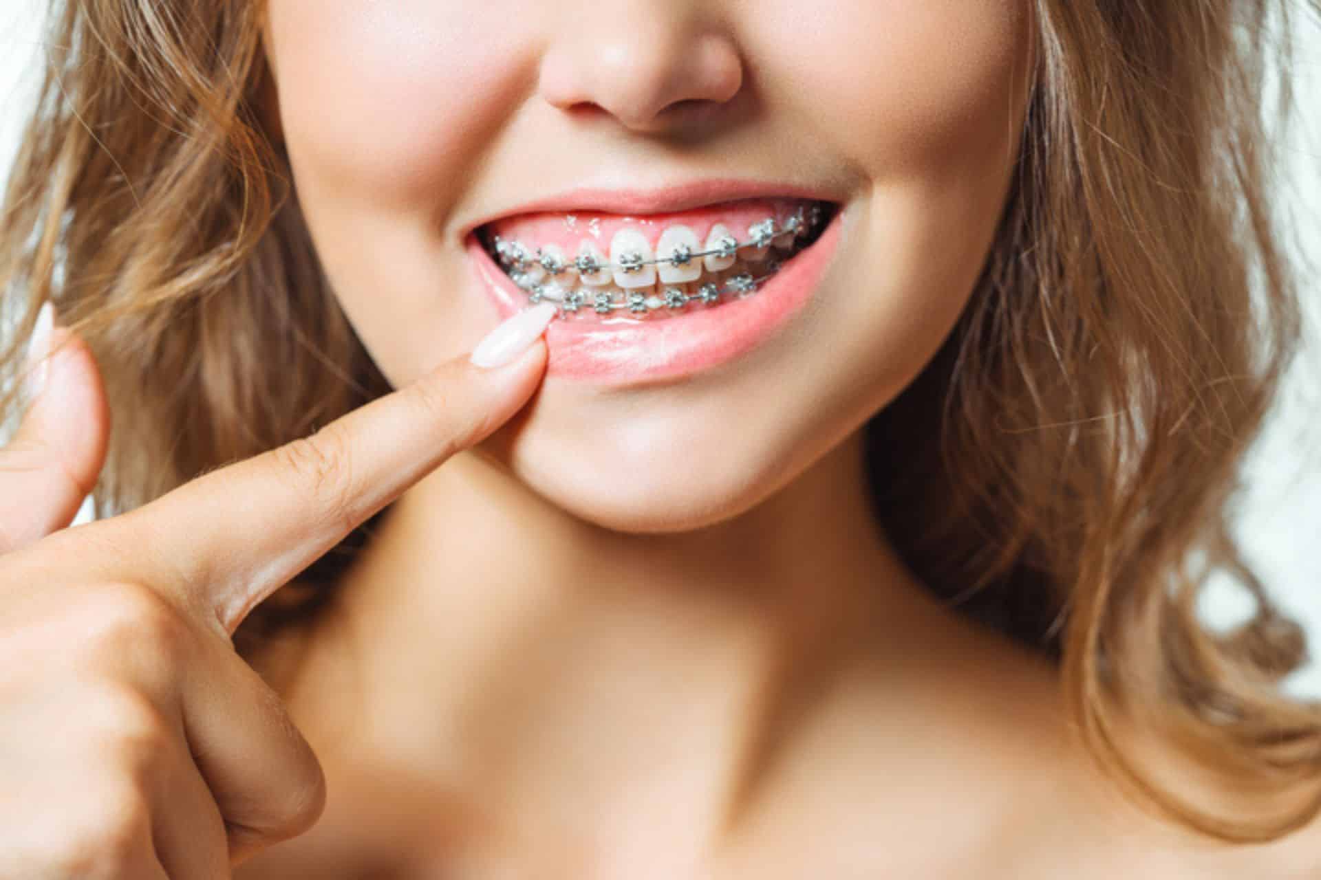 Can I Get Braces on Only My Top or Bottom Teeth? Enoch & Lamei Orthodontics